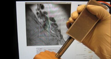Une nouvelle sonde portable pour détecter précocement  le cancer de la bouche