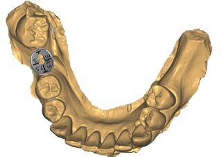 Fig. 18_Scelta della tabella digitale VPI appropriata sul modello Exocad.