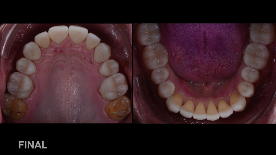 Fig. 3: Situación final, imagen intraoral: vista oclusal. Rehabilitación completa con restauraciones de composite nanohíbrido fresado.
