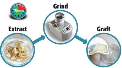 Dentists who are converting extracted teeth into bone graft report outstanding long-term results