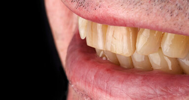 For age-appropriate esthetics: Natural effects with VITA VM materials