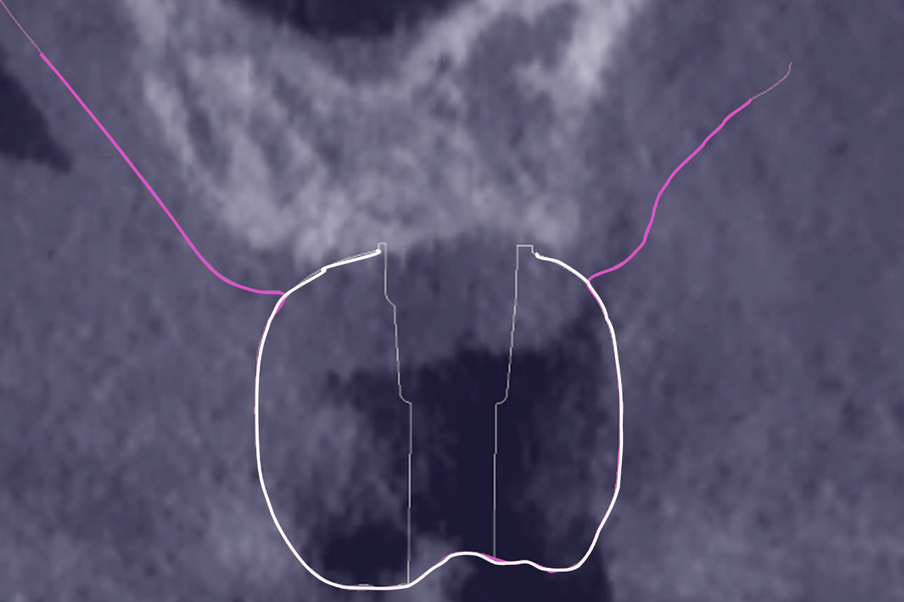 Fig. 5b: Merging of the STL file of the crown (white line) in addition.
