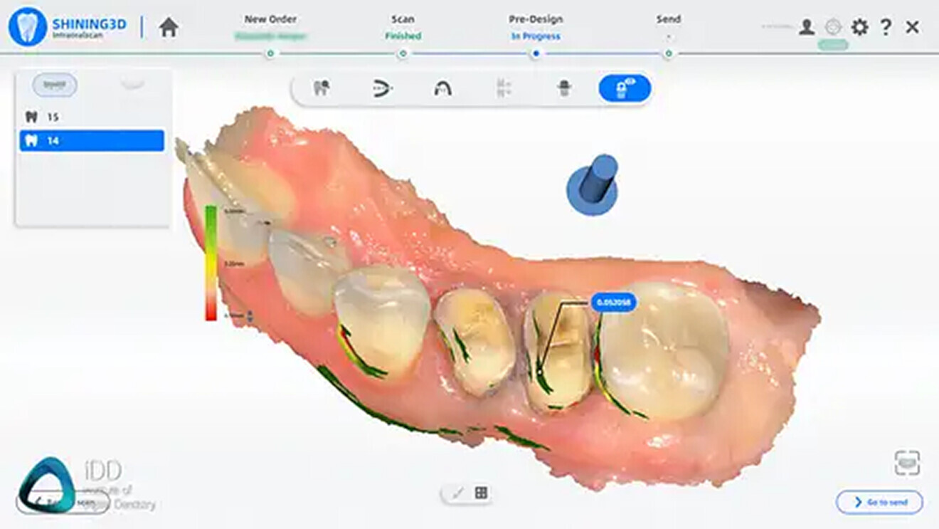 Fig. 13 & 14: A number of tools are included, such as undercut analysis and margin tools.