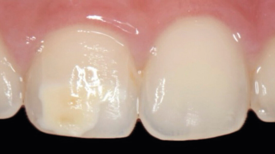 Fig. 4 - Lesione dopo 14 notti di trattamento, trattata con microabrasione a 6,6% acido cloridrico e microparticelle di carburo di silicio.