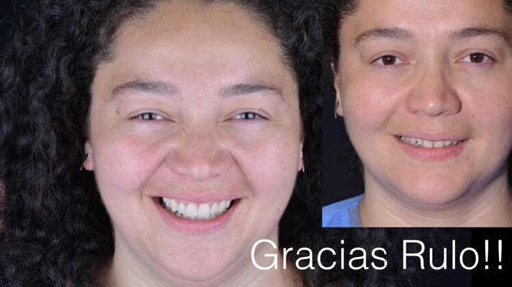 Dr. Mahn: Ceramic Contact Lenses: The Minimal Invasive Way Of Doing Veneers. Hands-On Course