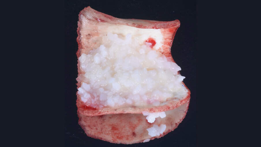Fig. 3 - Preparazione dell’innesto: la lamina in osso corticale appena inumidita, fornisce il supporto ai granuli eterologhi di origine equina precedentemente miscelati in rapporto 1:1 con gel a base di DBM.