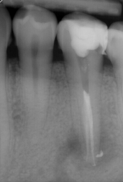 Fig. 6: Final radiograph after obturation.