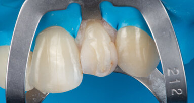 Restoring a peg-shaped lateral incisor with universal composite