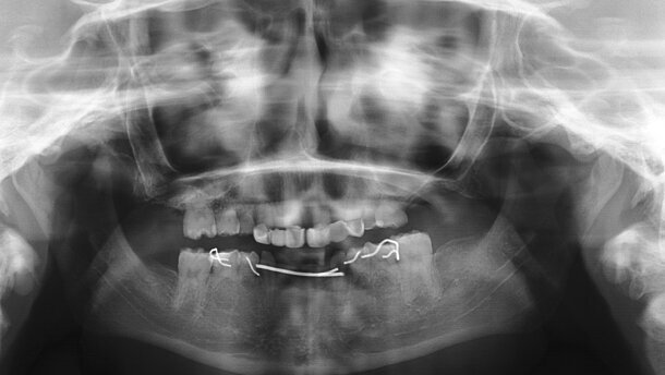 Carga inmediata de implantes en una niña con síndrome de Johanson-Blizzard