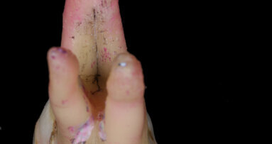 Cracking the code of fractured teeth