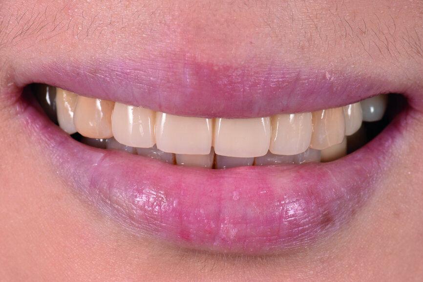 Fig. 20: The patient smiling
after adjustment of the labial contour of tooth #13.