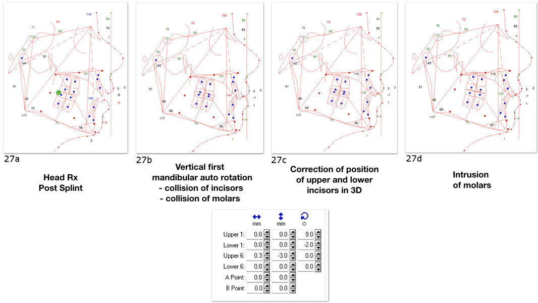 Figs. 27a–d: Visual treatment objectives. Situation after splint therapy (a). Situation after vertical first mandibular auto-rotation (b); collision of incisors and of molars. Situation after correction of position of the maxillary and mandibular incisors in 3D (c). Situation after molar intrusion (d).