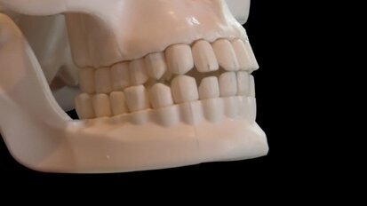 Suite à des microfissures, l´os est fortifié et plus apte à supporter un implant