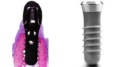 Zahnmediziner belegen Zuverlässigkeit von Implantaten