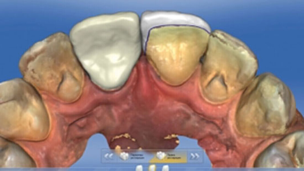 Fig. 6. Desde dorsal se aprecia virtualmente el borde palatino de la restauración con carilla.