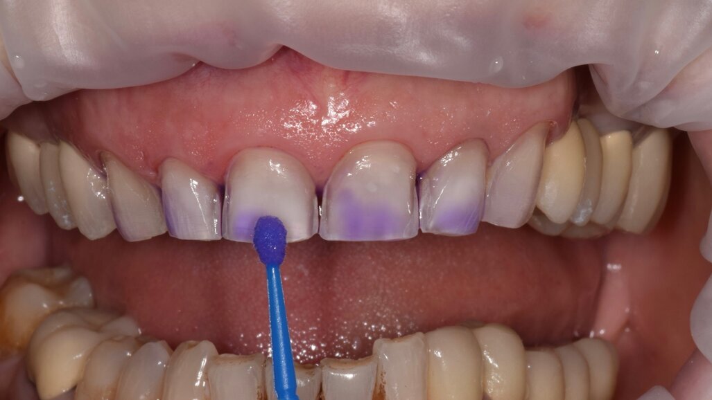 Làm sạch các phục hình răng cố định không có kim loại trước khi thực hiện các thủ thuật liên kết