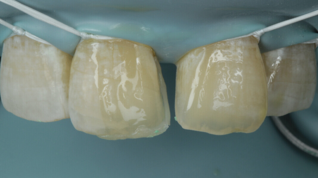 Fig 11.  A3 Enamel was used in this step.