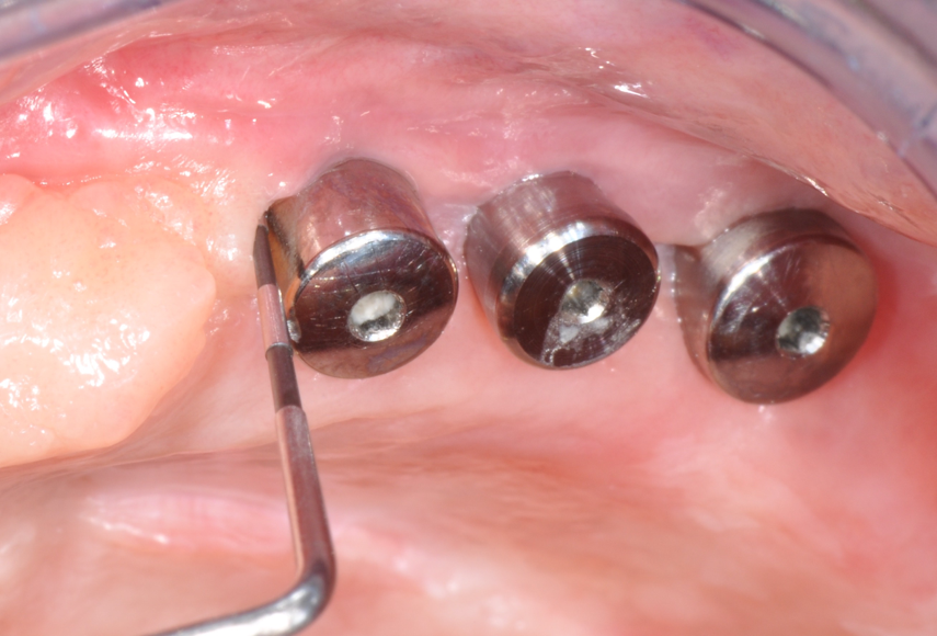 Fig.6: Resolution of mucositis after non-surgical therapy and healing period without bar. 