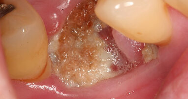 Study presents new treatment for jaw osteonecrosis around dental implants