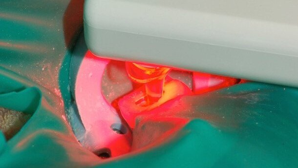 New Technologies—to improve root canal disinfection
