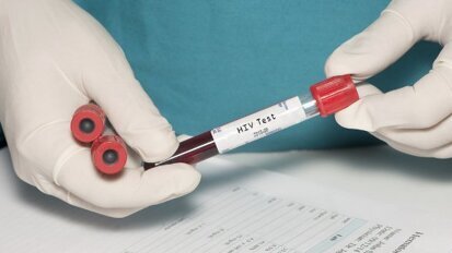 Продукти от пародонтопатогени могат да активират латентен HIV