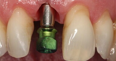 Placement of dental implants results in minimal bone loss, study shows