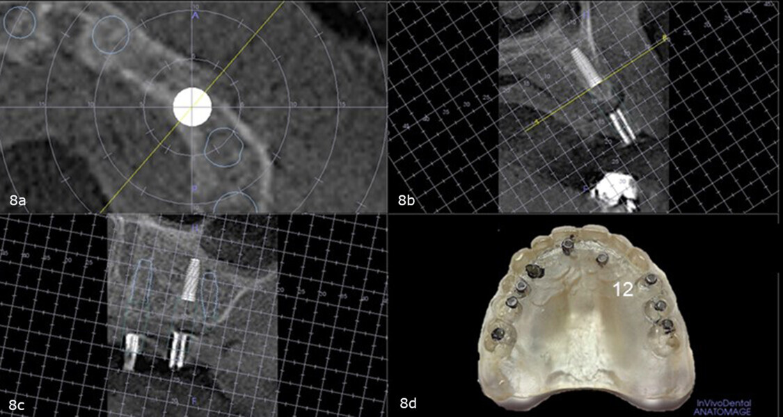 Figs. 8a–d: Virtual planning with the diagnostic guide placed intra-orally during the CBCT scan showing sufficient bone to accommodate a fixation screw in the maxillary left first premolar site and no need for angular or linear correction (a–c). Site on the duplicate denture (d).