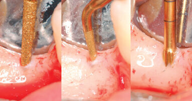 Una nuova tecnica per la preparazione del sito implantare con l’impiego della chirurgia piezoelettrica (PES)