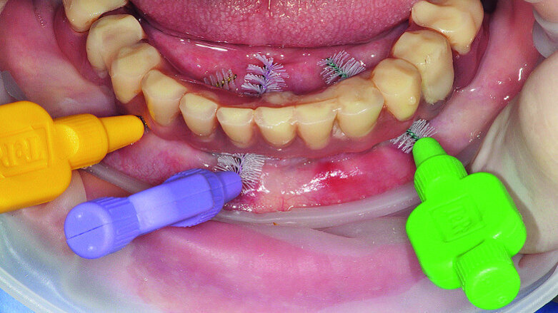 Prevention 0: The best way to prevent peri-implant disease?