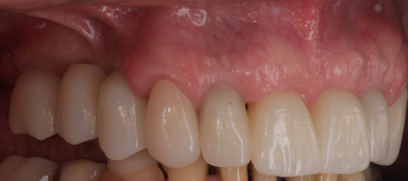 Fig. 20: Left lateral aspect of the restorations after the two-year follow-up period.