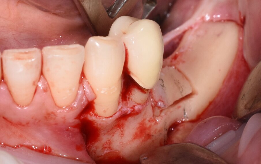 Fig. 6 - Taglio osteotomico eseguito con inserto piezoelettrico.