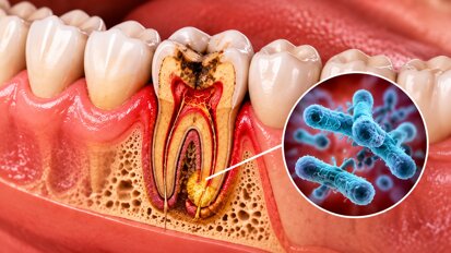 Las infecciones dentales no tratadas pueden causar complicaciones cardiacas