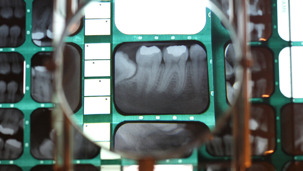 Artificial intelligence shows promise for detecting periodontal status in bitewing radiographs