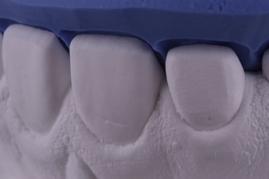 Fig. 38: Sectioned silicone key on the plaster model for laboratory
reduction.
