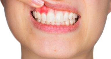 Optimised diet for oral health reduces gingivitis