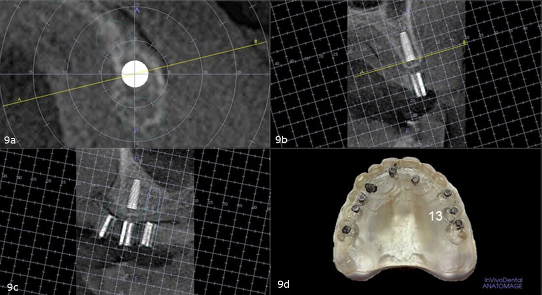Figs. 9a–d: Virtual planning with the diagnostic guide placed intra-orally during the CBCT scan showing sufficient bone to accommodate an implant in the maxillary left second premolar site and no need for angular or linear correction (a–c). Site on the duplicate denture (d).