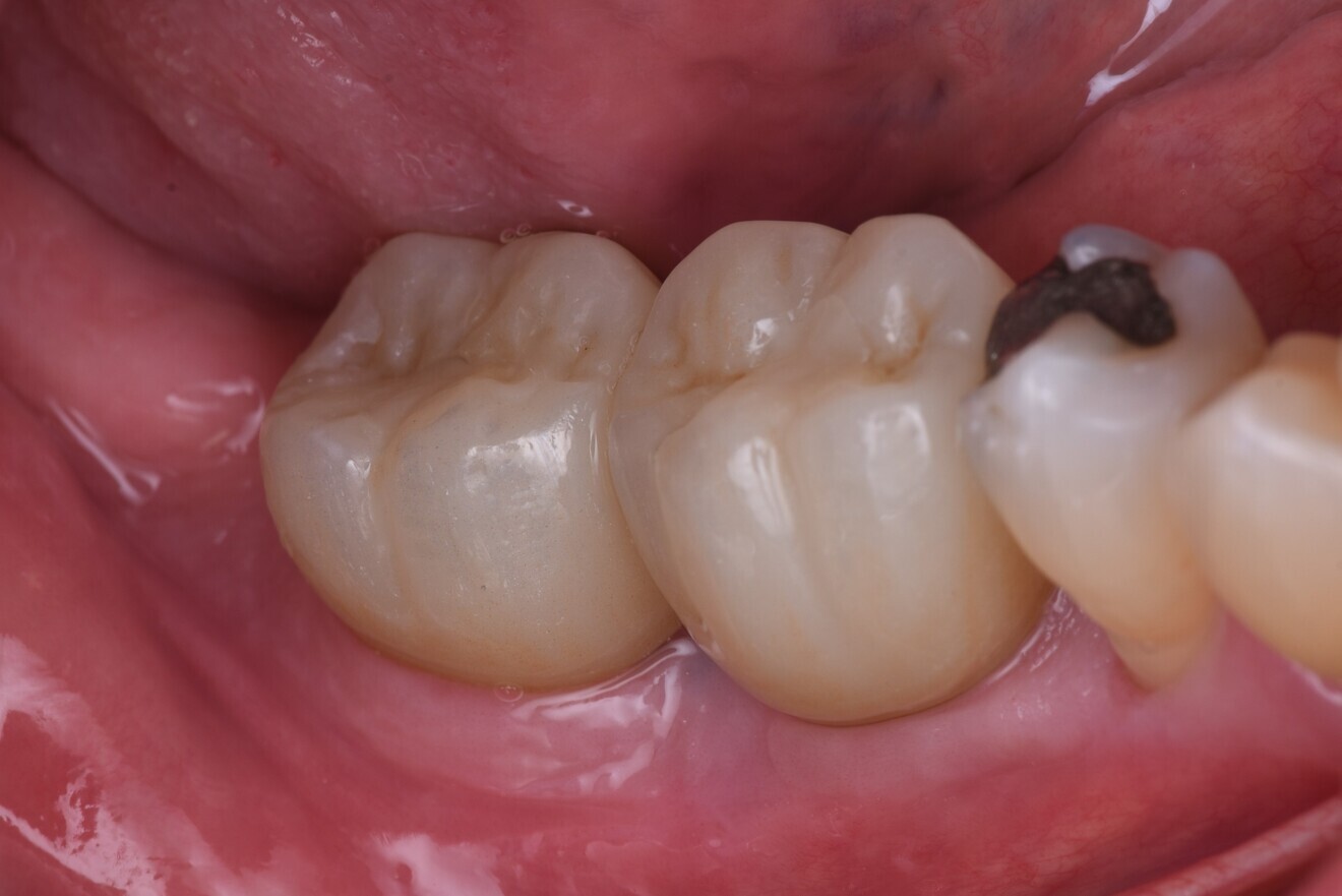 Fig. 14: Definitive zirconia crowns placed, labial view.