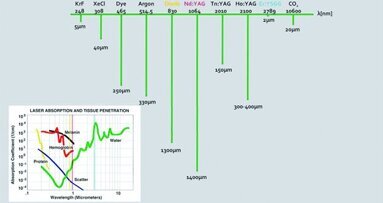 Utilisation clinique du laser Er,Cr:YSGG dans le traitement endodontique