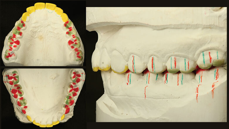 The gold standard: IPS e.max Press – one  material for virtually all indications?!