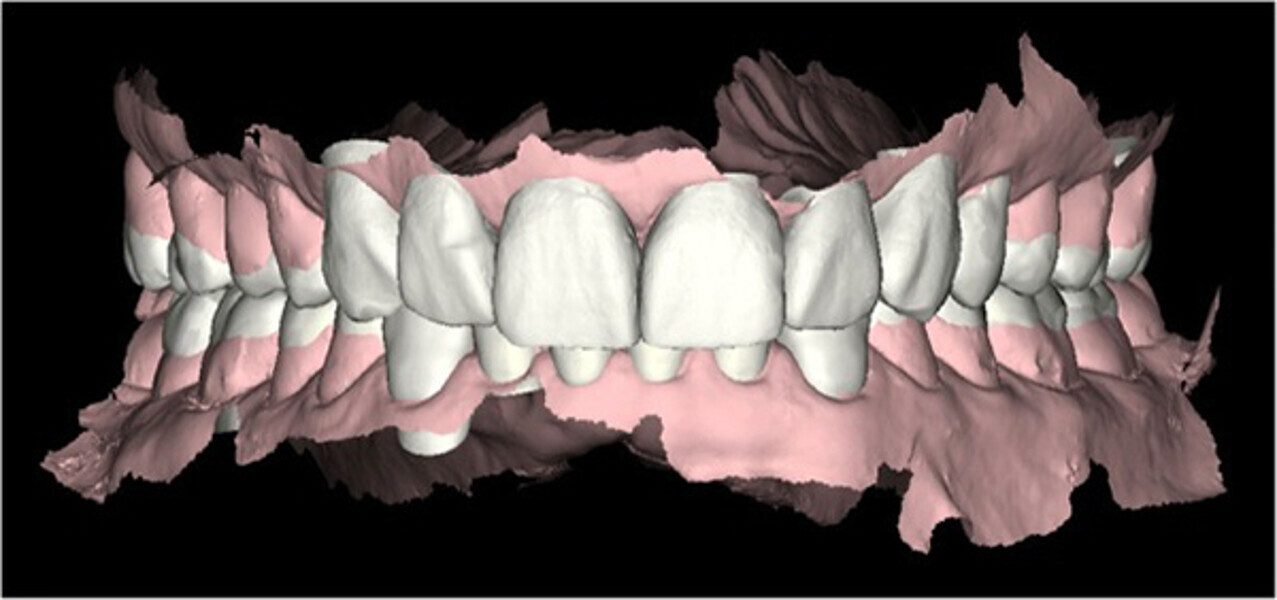 Fig. 3. Escaneado intraoral inicial con Carestream 3500.