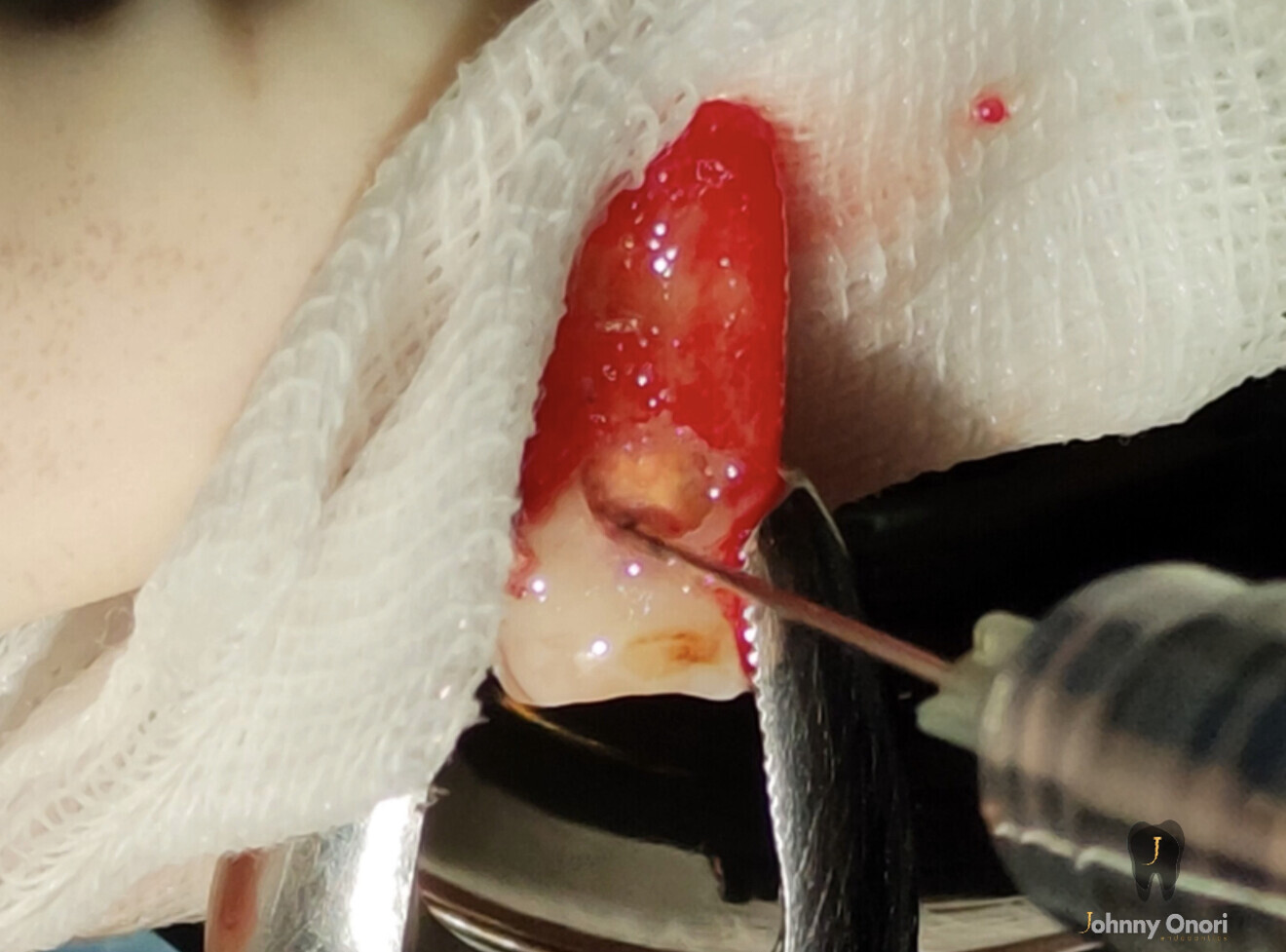 Fig. 4a: Surgical extrusion and sealing of the resorption. Trichloracetic acid was applied with a cotton pellet in order to remove all the resorptive tissue.