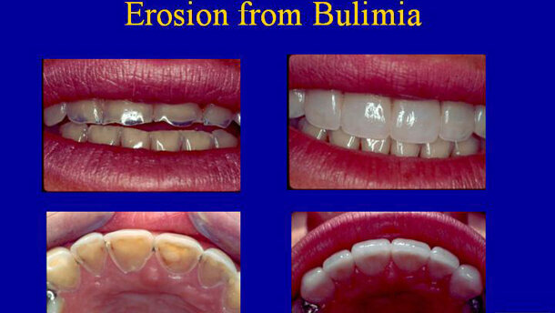 Dentists are often able to spot eating disorders in patients
