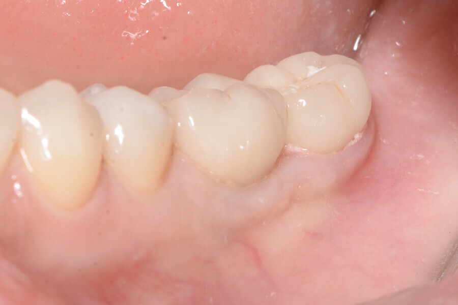 Fig. 19 : Aspect clinique de la zone des tissus mous péri-implantaires lors du suivi à cinq ans.
