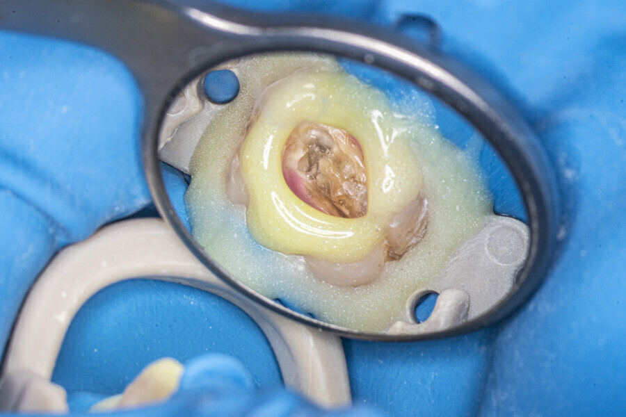 Fig. 50: Temporary build-up for increasing the amount of irrigant during the Less-Prep Endo enhanced irrigation protocol. The pulp chamber calcification could be seen.