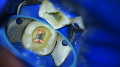 From a distal