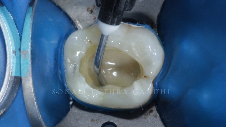 Fig 7: Application of Flowable Composite