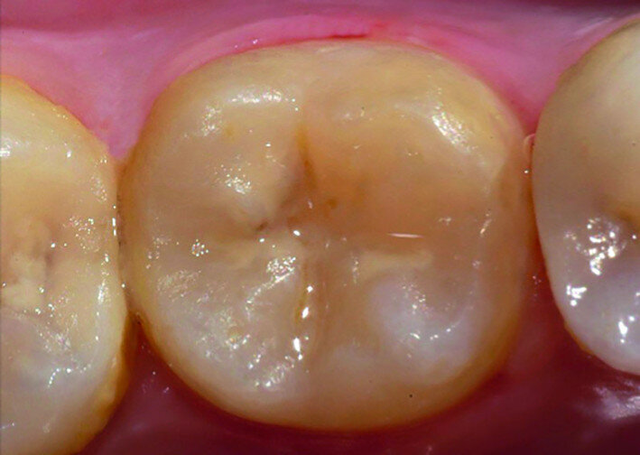 Fig. 16d: Clinical image after 11 years of function.