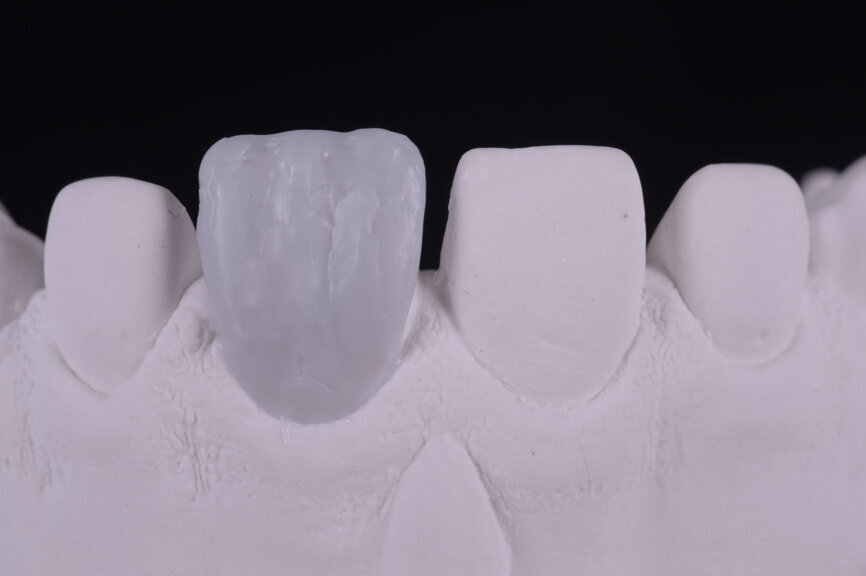 Fig. 24: Wax-up of the entire facial area, frontal and lateral views.