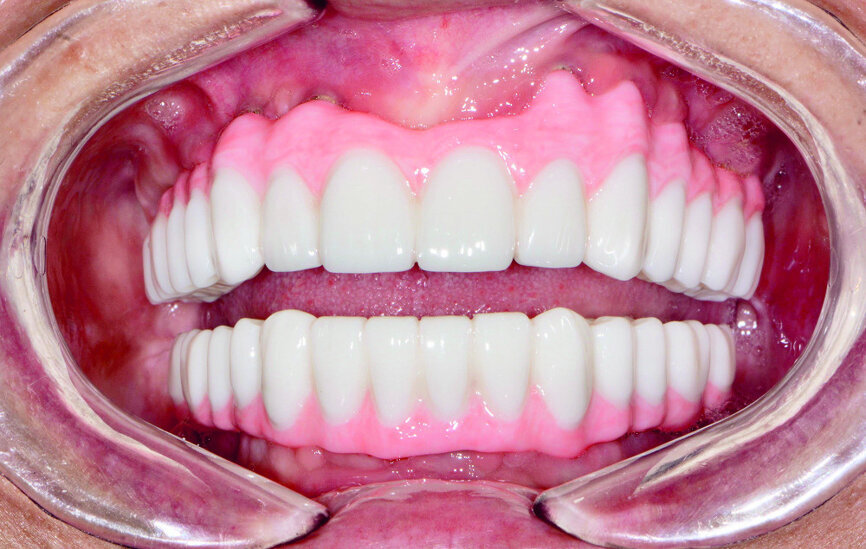 Fig 21 Vue des dents non engrenées