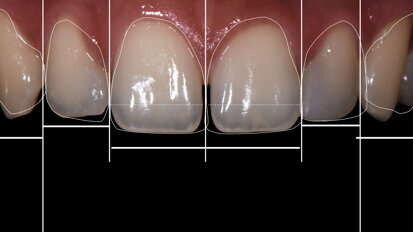 Diastema closure using a direct two-matrix technique